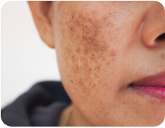 Ação contra melasma